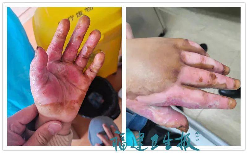 男孩玩鞭炮9级伤残;男童玩鞭炮手炸伤